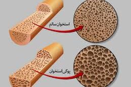 کدام گروه بیشتر در معرض پوکی استخوان هستند؟