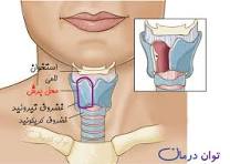 آیا مواد غذایی رفلاکس حنجره را تشدید می‌کند؟