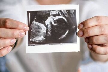 ویتامین D بیشتر مادر در بارداری با کاهش پوسیدگی دندان کودکان مرتبط است