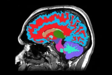 ۱۰ علامت اولیه و غافلگیرکننده زوال عقل که نباید نادیده گرفته شوند