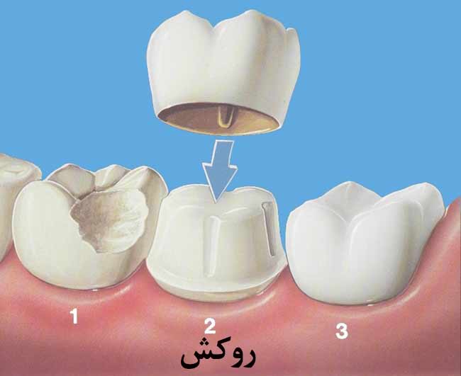 روکش دندان را بهتر و بیشتر بشناسیم